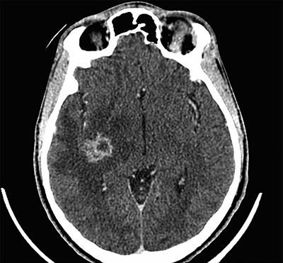 Case Report: Invasive Cryptococcosis in French Guiana: Immune and Genetic Investigation in Six Non-HIV Patients